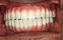 After - Veneered Implant Bridge