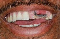 Before - Veneered Implant Bridge